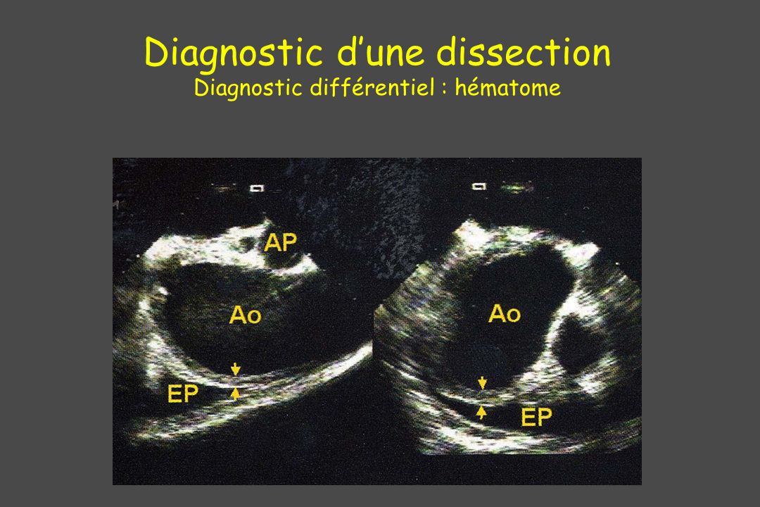 Diagnostic d’une dissection Diagnostic différentiel : hématome
