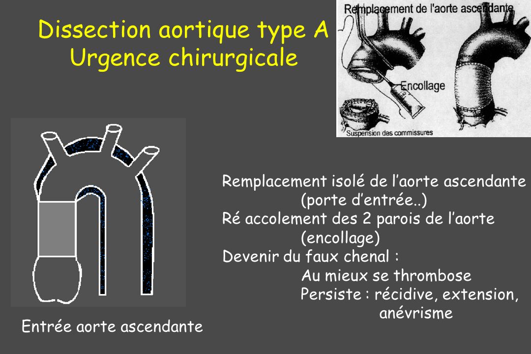 Dissection aortique type A Urgence chirurgicale