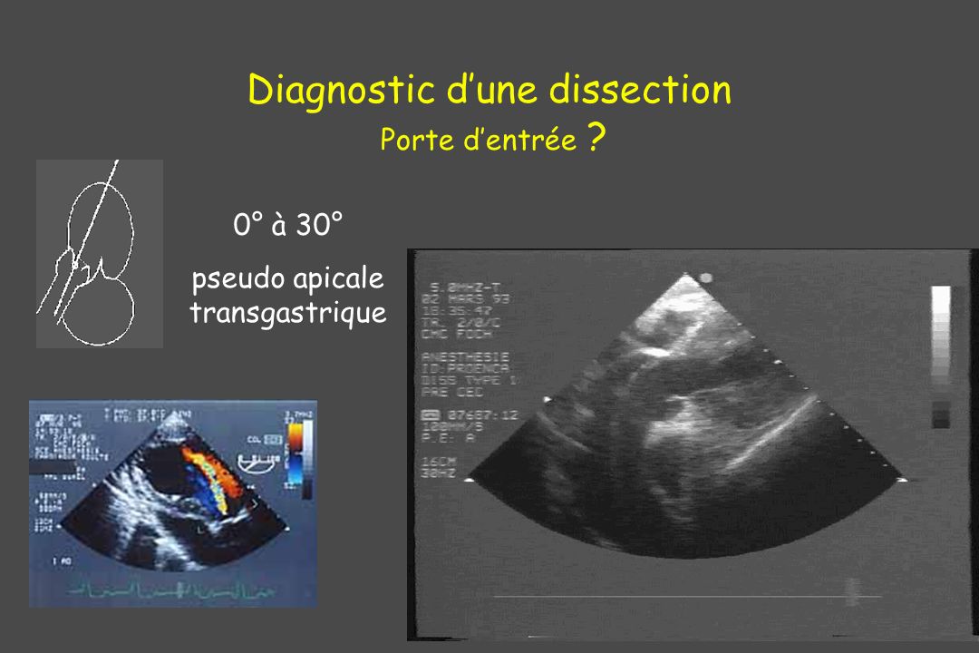 Diagnostic d’une dissection Porte d’entrée
