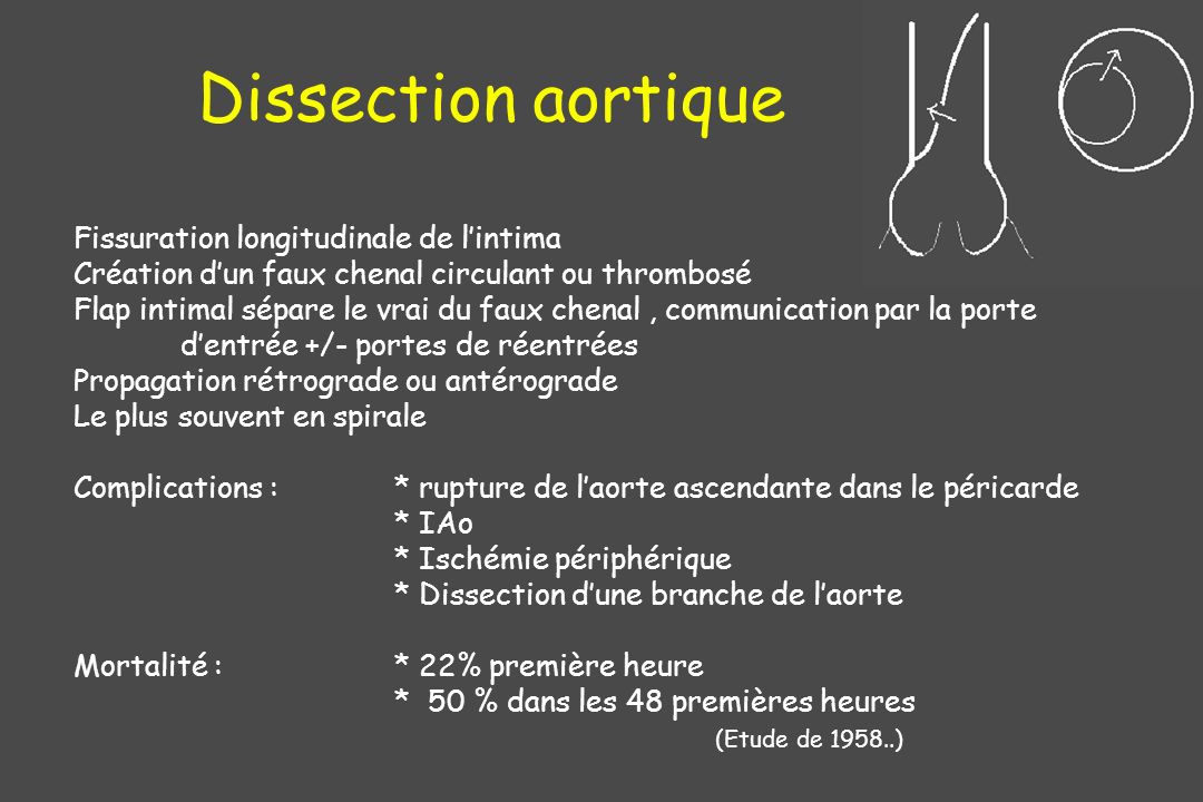 Dissection aortique Fissuration longitudinale de l’intima