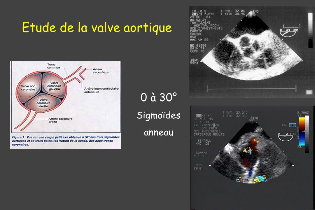 Etude de la valve aortique