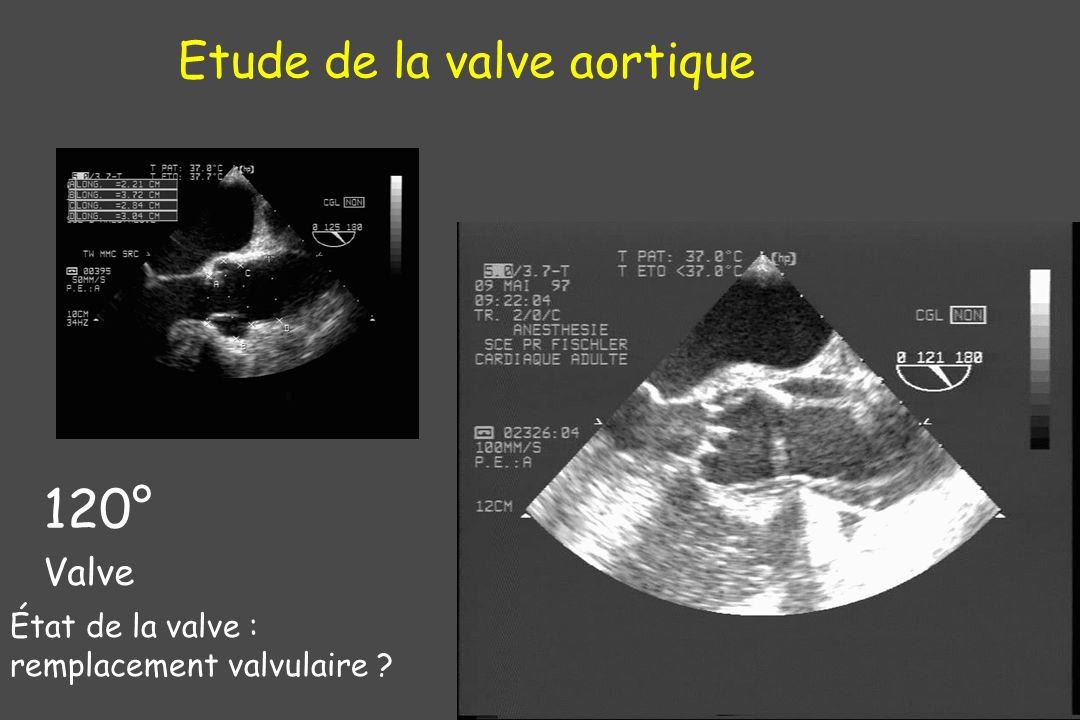 Etude de la valve aortique
