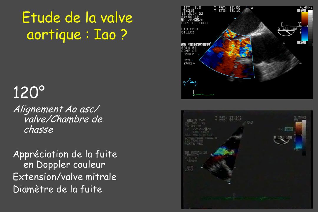 Etude de la valve aortique : Iao
