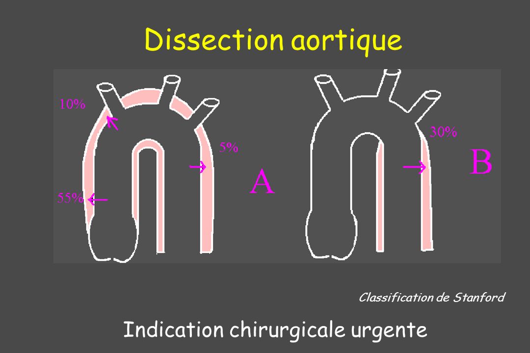 Dissection aortique Indication chirurgicale urgente
