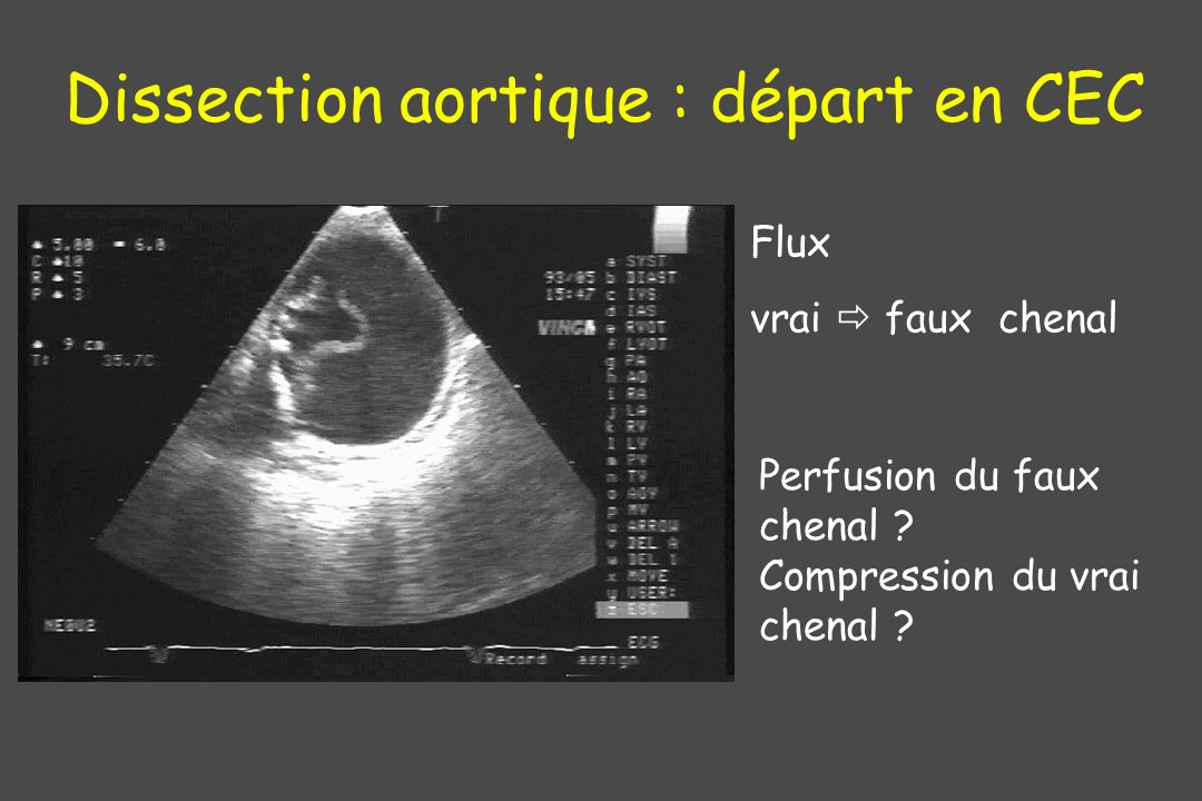 Dissection aortique : départ en CEC