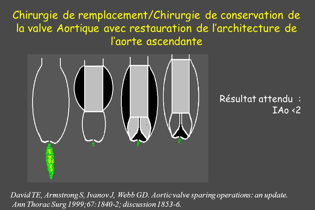 Chirurgie de remplacement/Chirurgie de conservation de la valve Aortique avec restauration de l’architecture de l’aorte ascendante