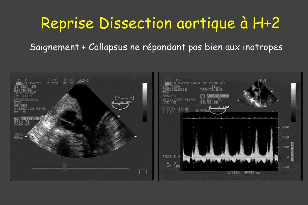 Reprise Dissection aortique à H+2