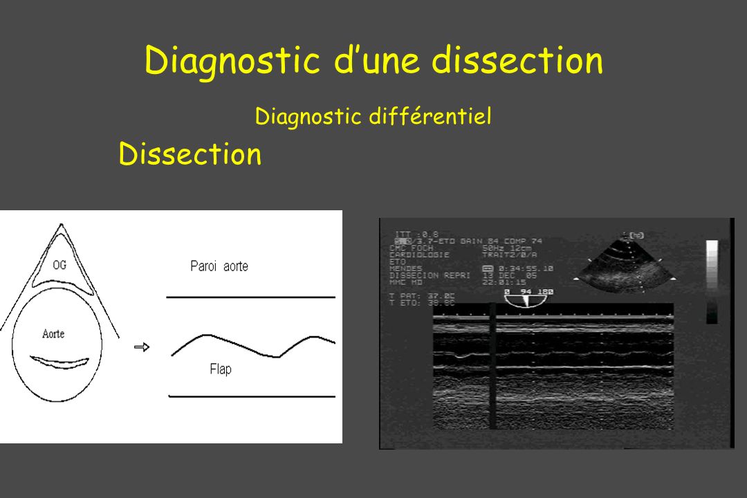 Diagnostic d’une dissection Diagnostic différentiel