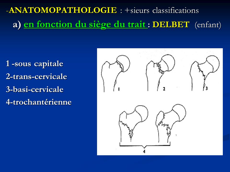 -ANATOMOPATHOLOGIE : +sieurs classifications a) en fonction du siège du trait : DELBET (enfant) 1 -sous capitale 2-trans-cervicale 3-basi-cervicale 4-trochantérienne