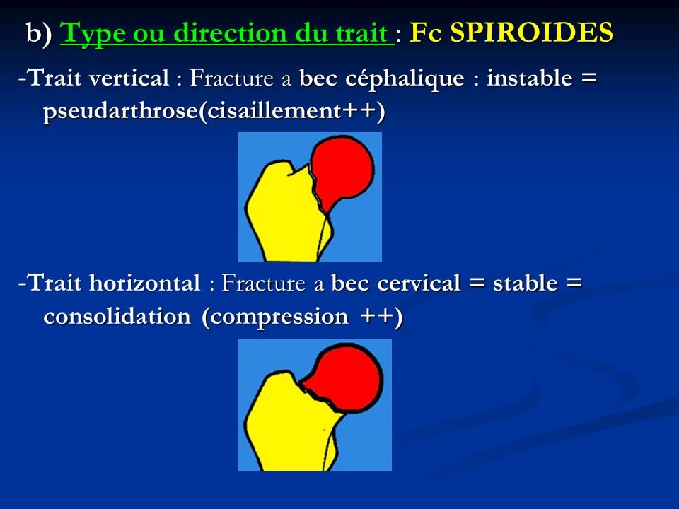 b) Type ou direction du trait : Fc SPIROIDES -Trait vertical : Fracture a bec céphalique : instable = pseudarthrose(cisaillement++) -Trait horizontal : Fracture a bec cervical = stable = consolidation (compression ++)