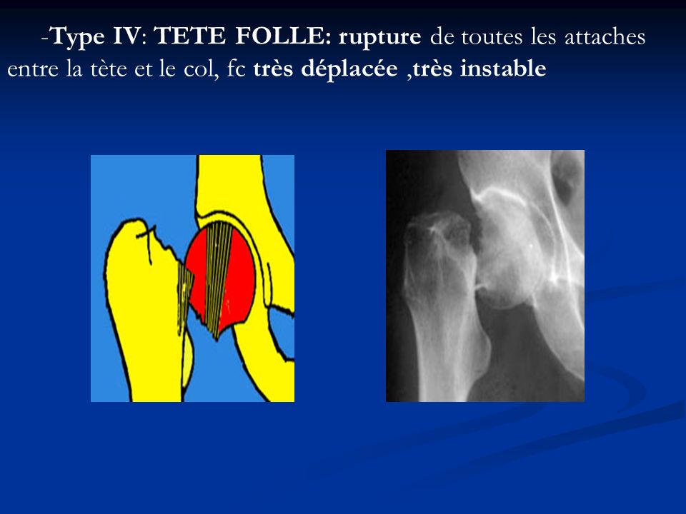 -Type IV: TETE FOLLE: rupture de toutes les attaches entre la tète et le col, fc très déplacée ,très instable