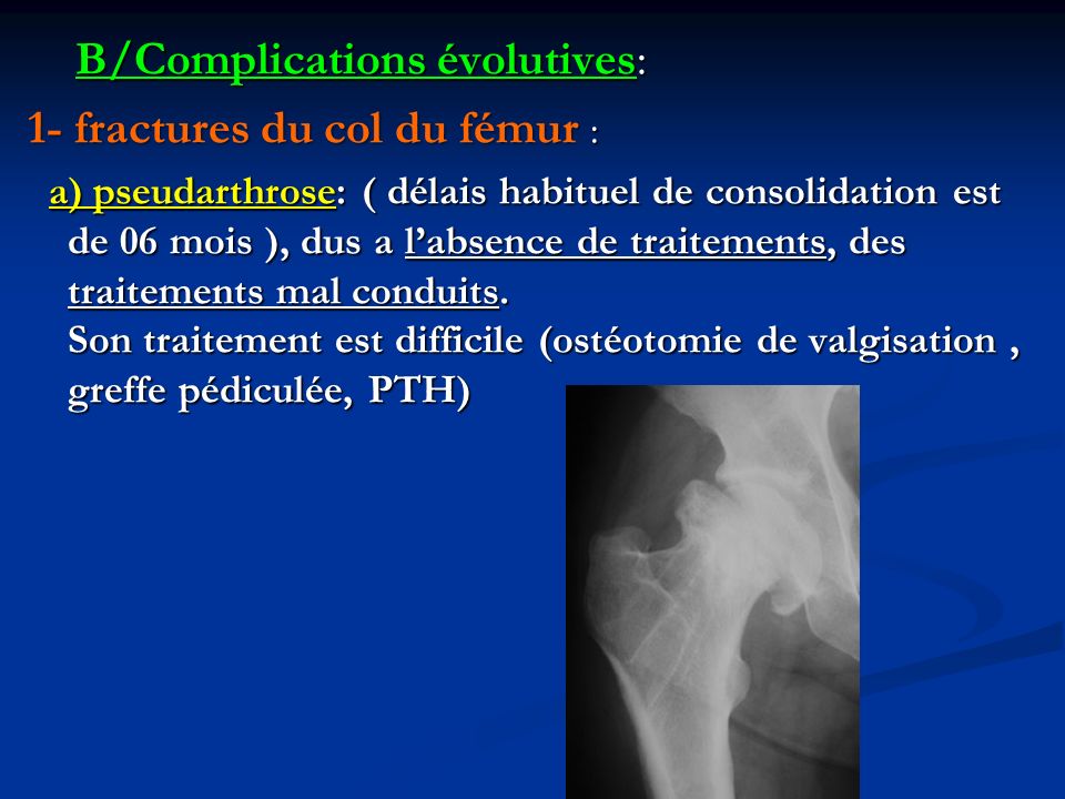 B/Complications évolutives: 1- fractures du col du fémur :