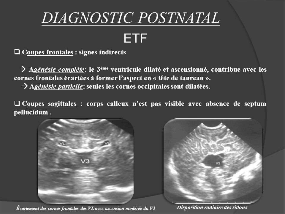 DIAGNOSTIC POSTNATAL ETF Coupes frontales : signes indirects