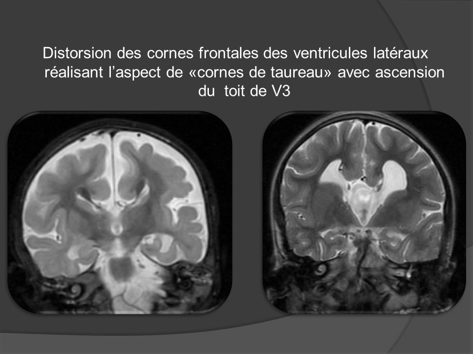 Distorsion des cornes frontales des ventricules latéraux réalisant l’aspect de «cornes de taureau» avec ascension du toit de V3