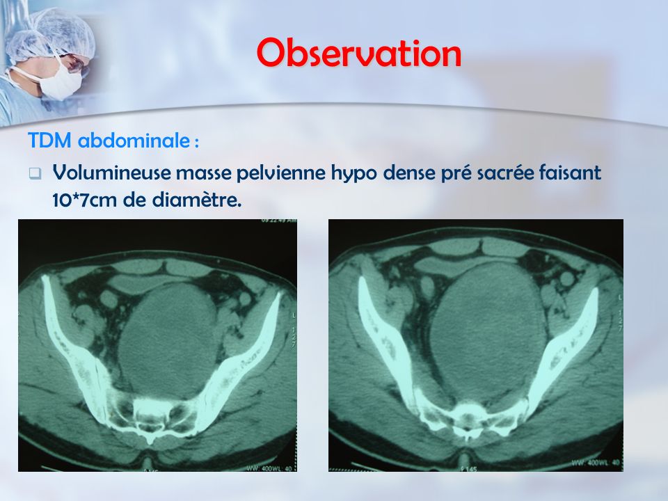 Observation TDM abdominale :