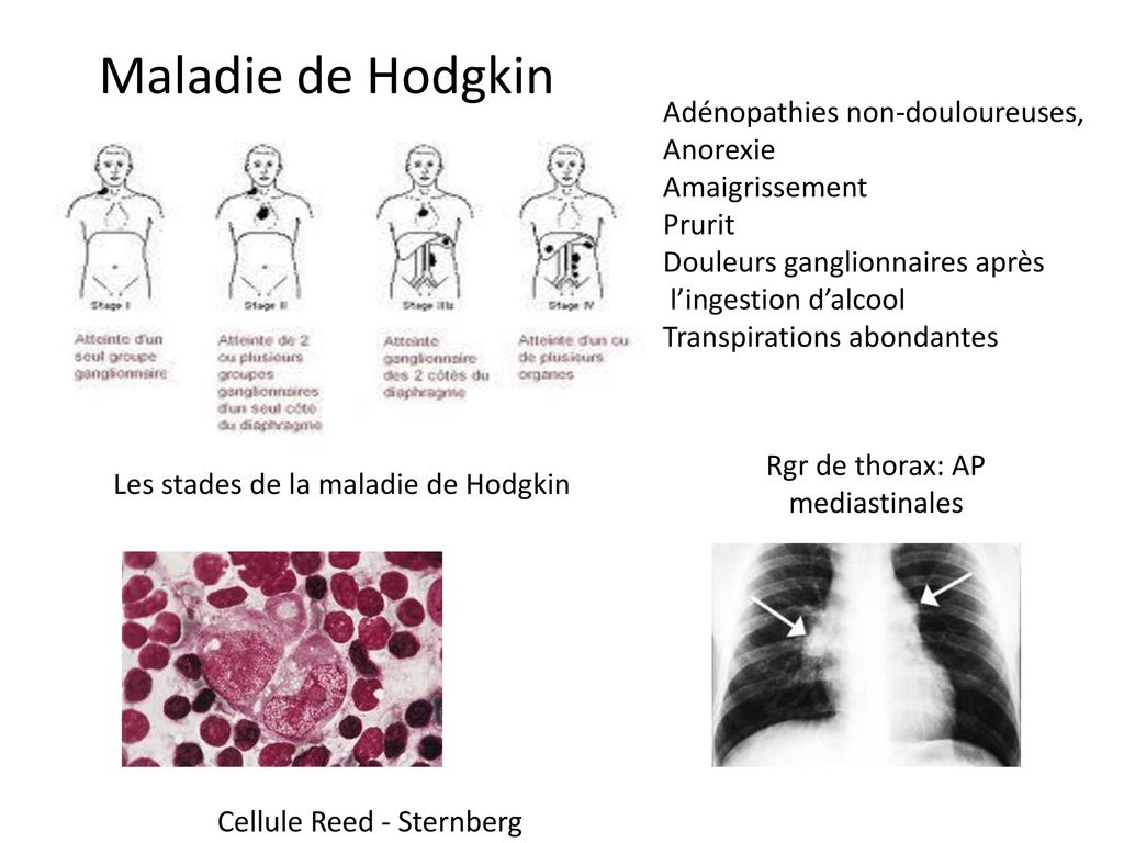 Maladie de Hodgkin Adénopathies non-douloureuses, Anorexie
