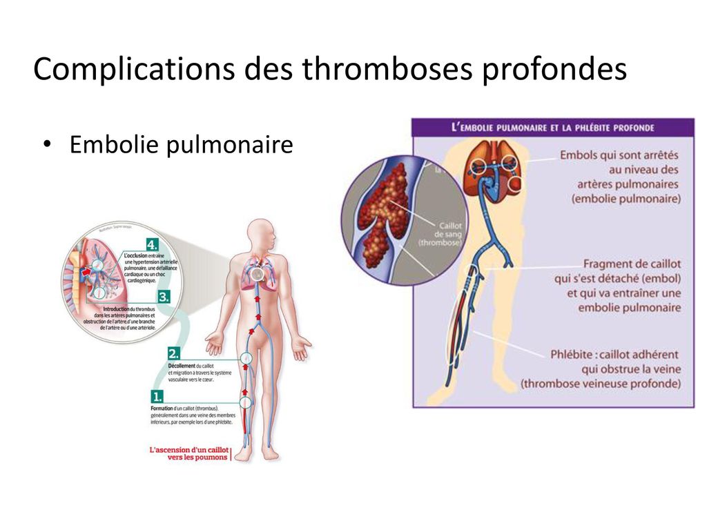 Complications des thromboses profondes