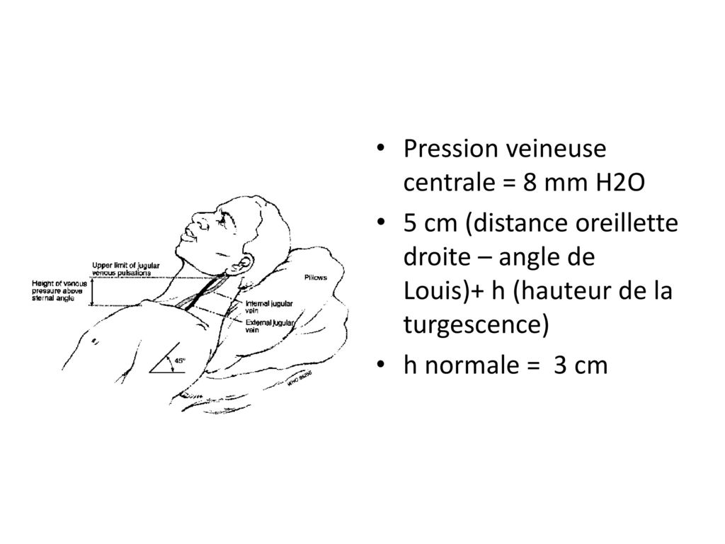 Pression veineuse centrale = 8 mm H2O