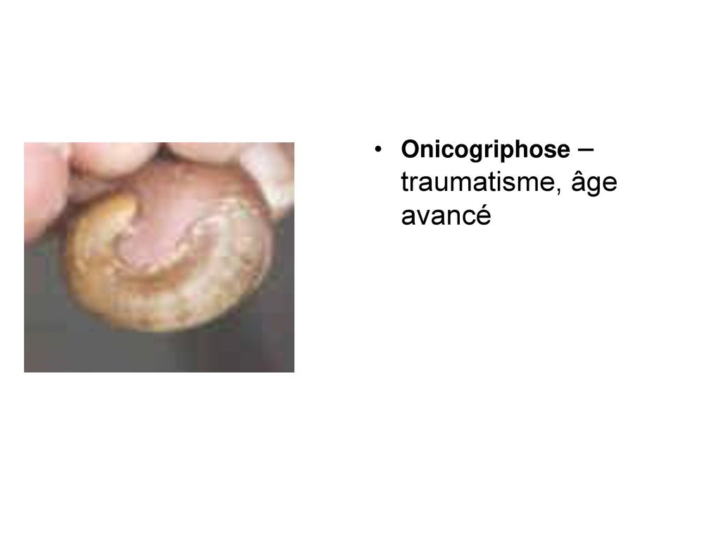 Onicogriphose – traumatisme, âge avancé