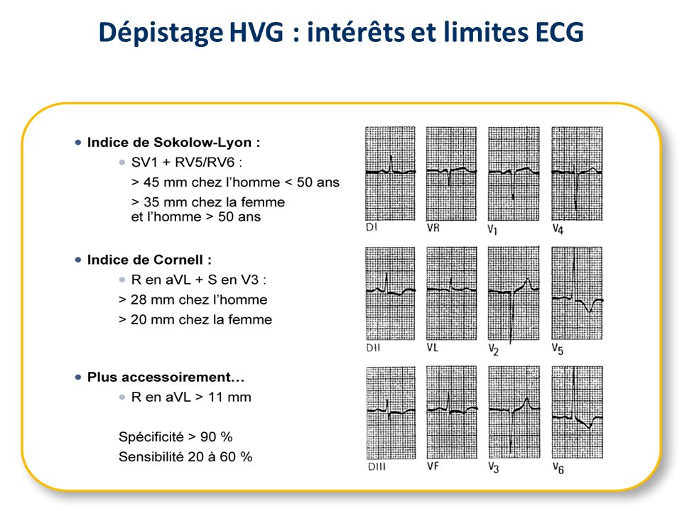 Dépistage HVG : intérêts et limites ECG
