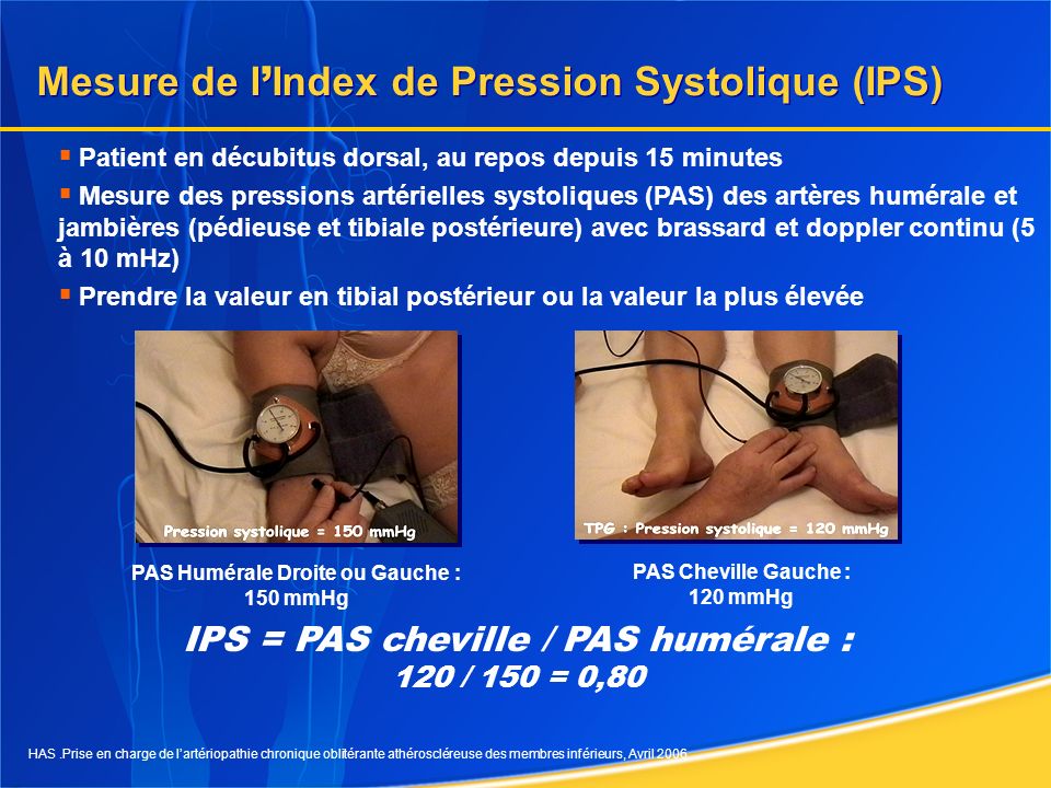 Mesure de l’Index de Pression Systolique (IPS)