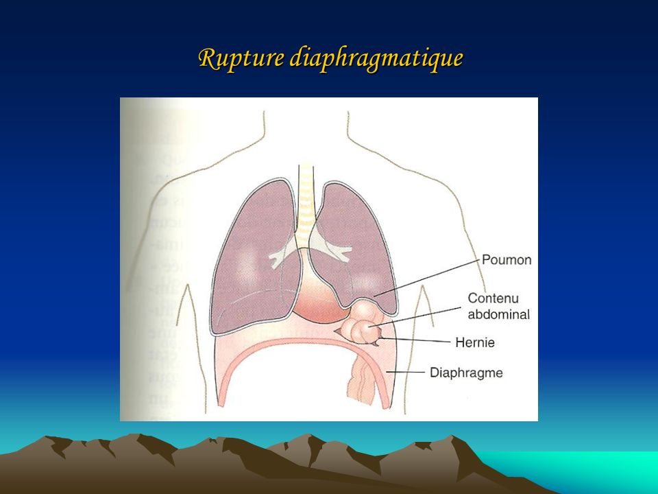 Rupture diaphragmatique