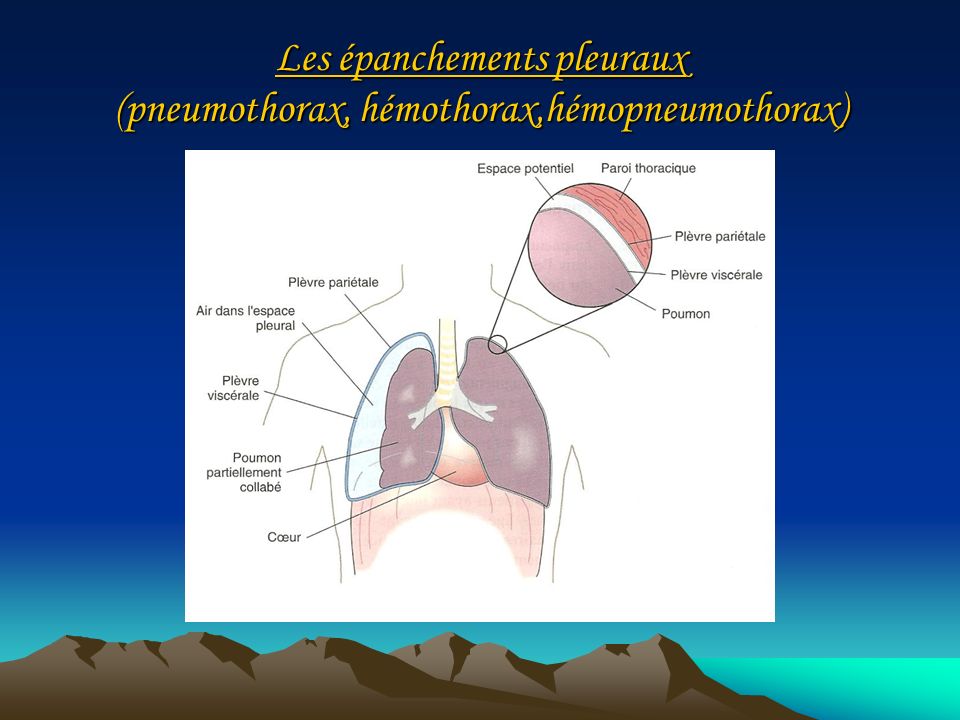Les épanchements pleuraux (pneumothorax, hémothorax,hémopneumothorax)