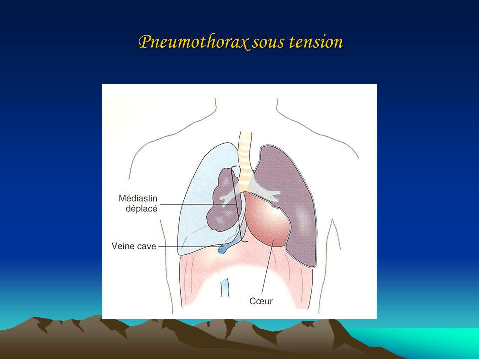 Pneumothorax sous tension