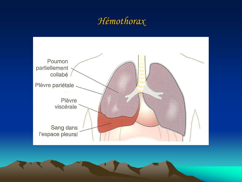 Hémothorax