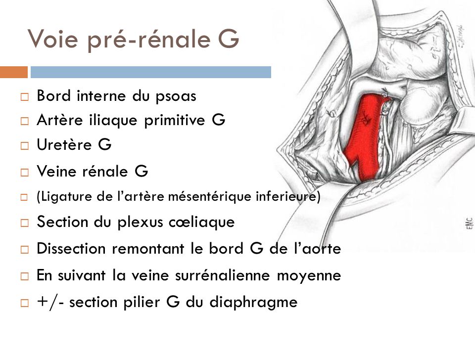 Voie pré-rénale G Bord interne du psoas Artère iliaque primitive G