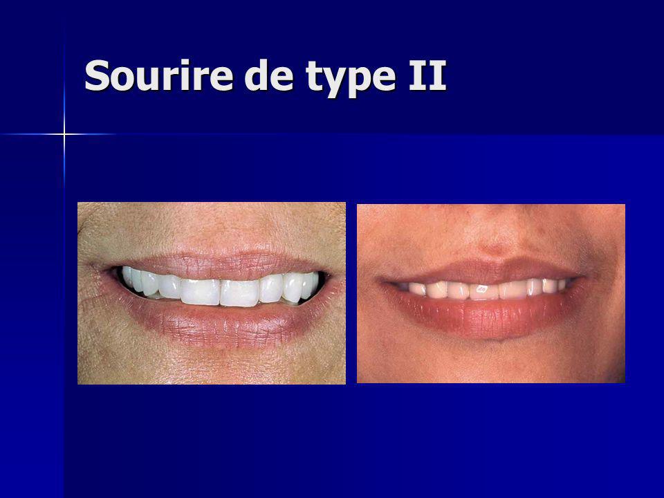 Sourire de type II - … le sourire de type II ne peut disposer d’une aussi grande variabilité de courbe.