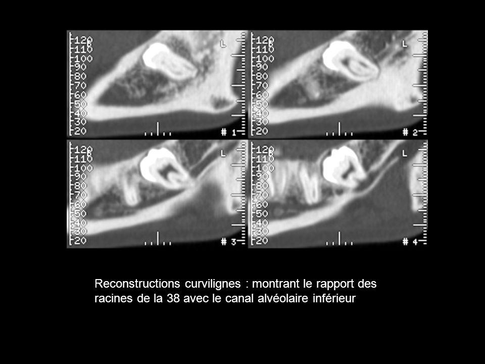 Reconstructions curvilignes : montrant le rapport des racines de la 38 avec le canal alvéolaire inférieur