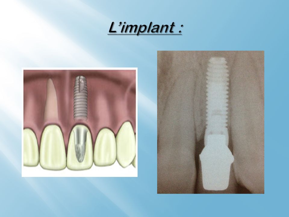 L’implant :