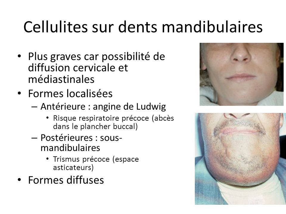 Cellulites sur dents mandibulaires
