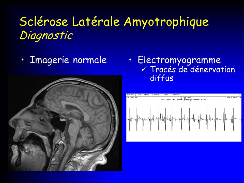 Sclérose Latérale Amyotrophique