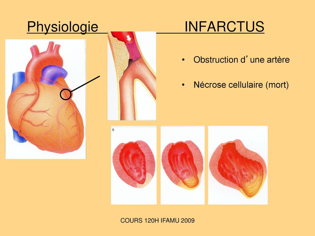Physiologie INFARCTUS