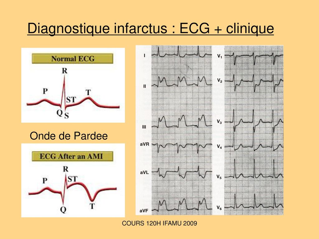 Diagnostique infarctus : ECG + clinique