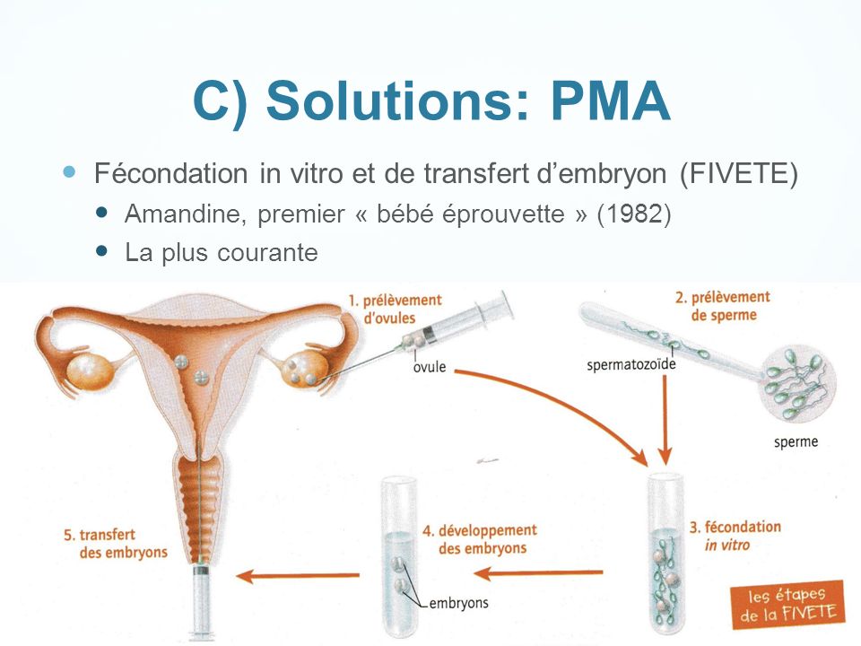 C) Solutions: PMA Fécondation in vitro et de transfert d’embryon (FIVETE) Amandine, premier « bébé éprouvette » (1982)