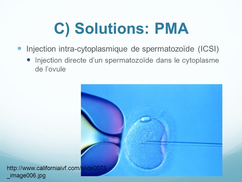 C) Solutions: PMA Injection intra-cytoplasmique de spermatozoïde (ICSI) Injection directe d’un spermatozoïde dans le cytoplasme de l’ovule.