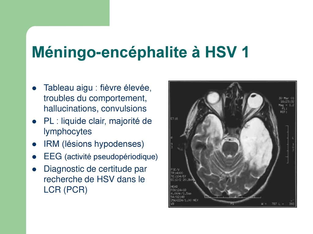 Méningo-encéphalite à HSV 1