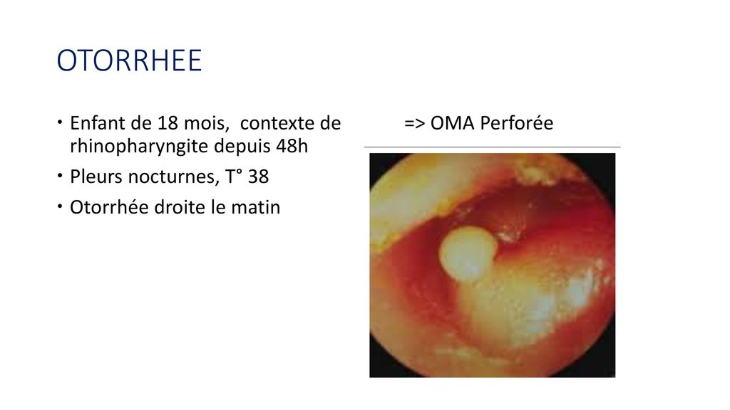 OTORRHEE Enfant de 18 mois, contexte de rhinopharyngite depuis 48h