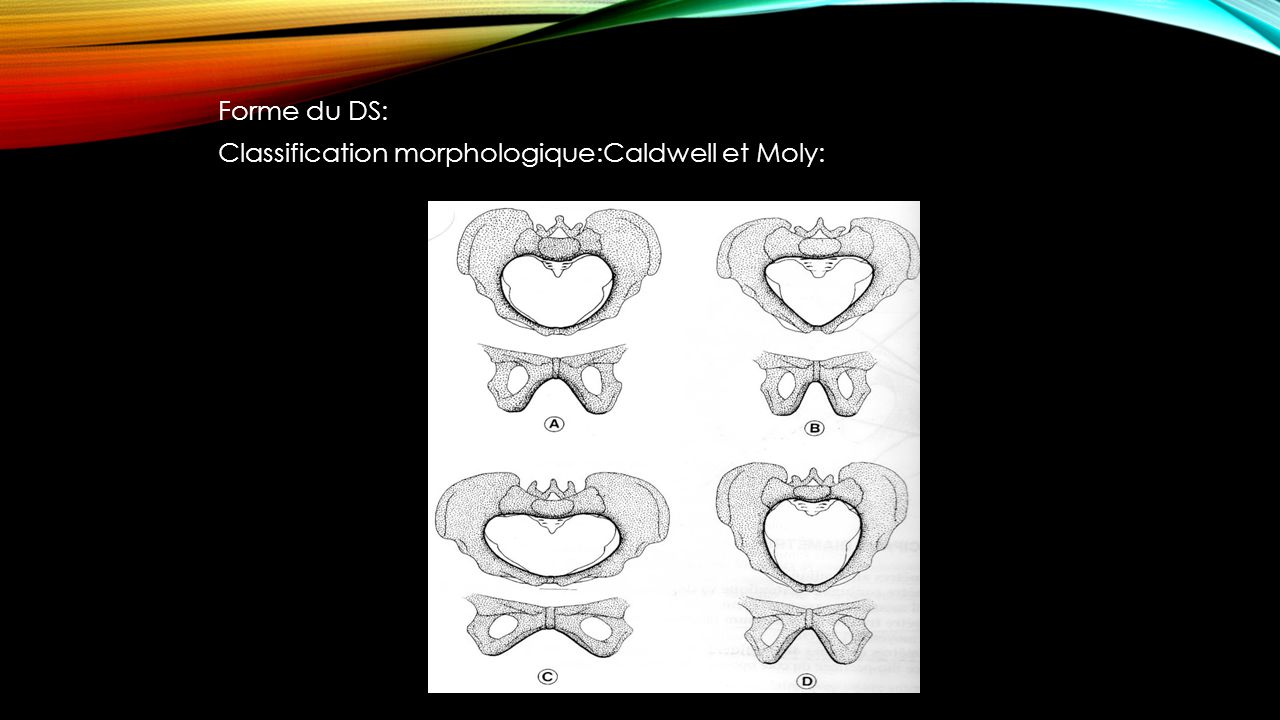 Forme du DS: Classification morphologique:Caldwell et Moly: