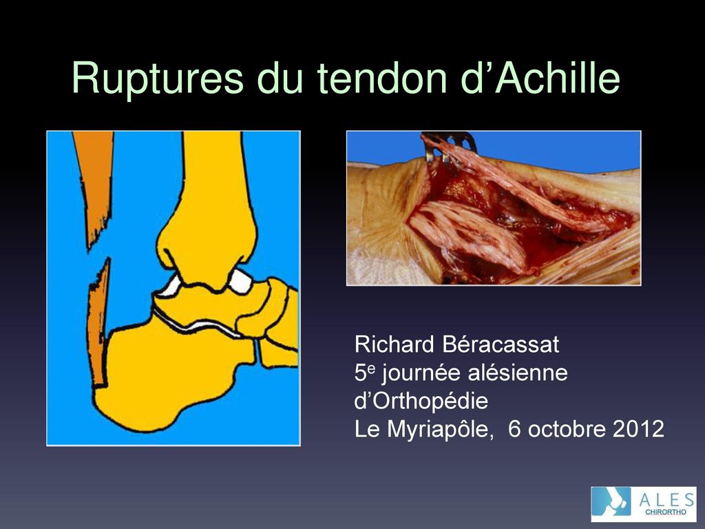 Ruptures du tendon d’Achille