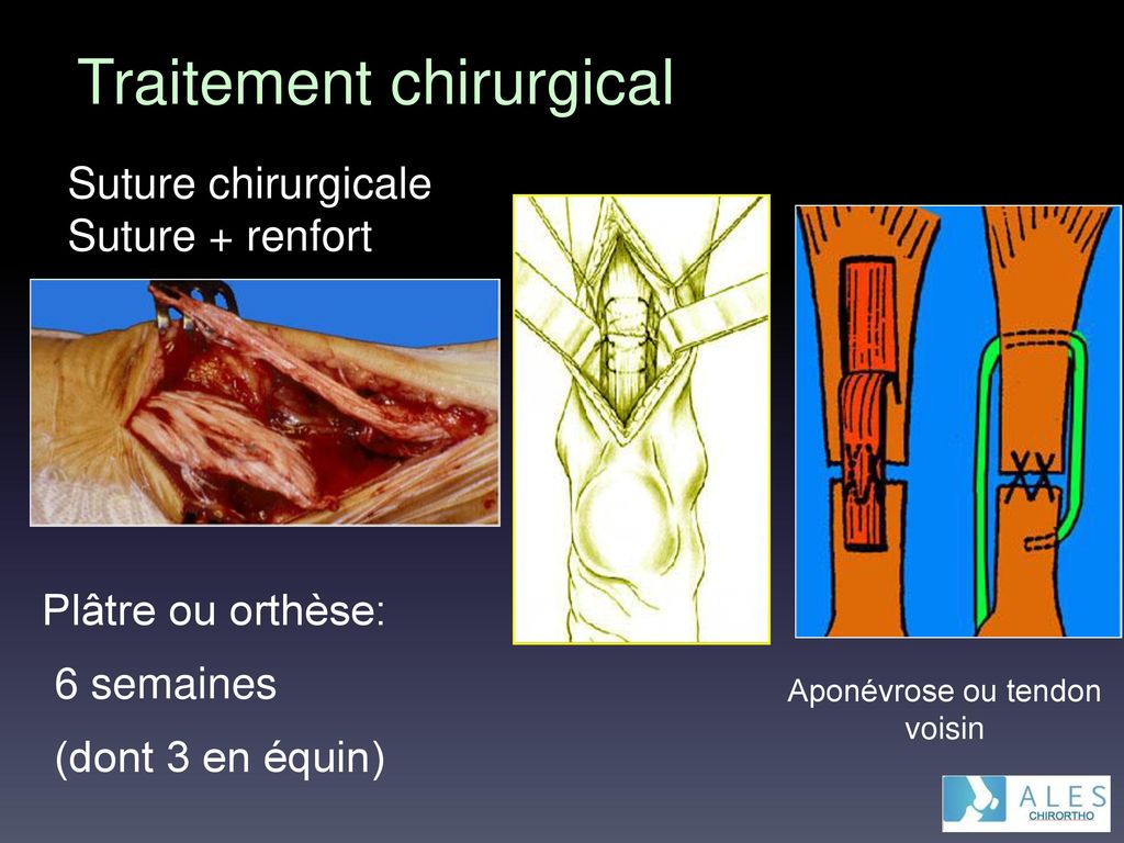 Suture chirurgicale Suture + renfort