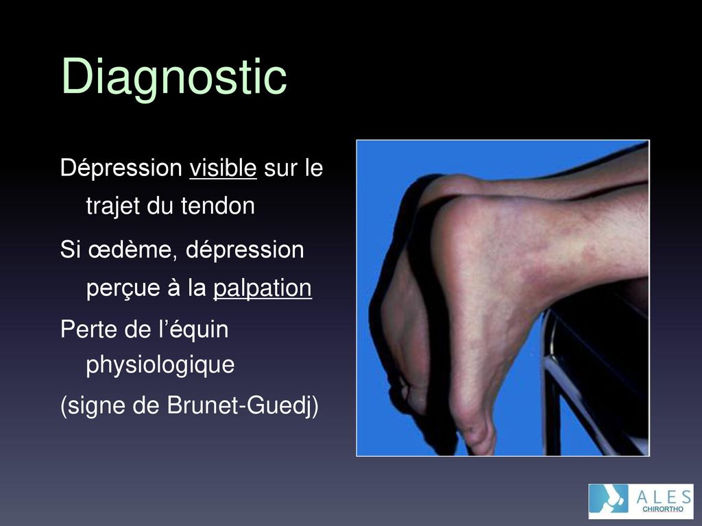 Diagnostic Dépression visible sur le trajet du tendon