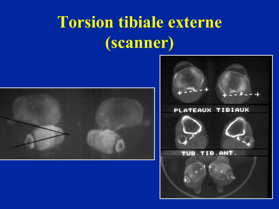 Torsion tibiale externe (scanner)