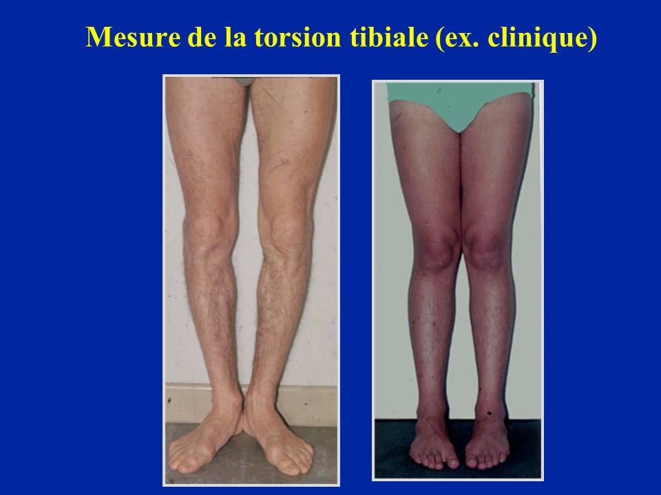 Mesure de la torsion tibiale (ex. clinique)