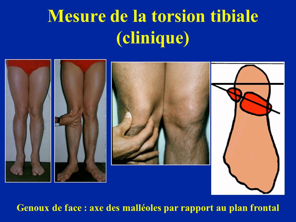 Mesure de la torsion tibiale (clinique)