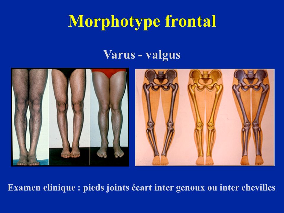 Morphotype frontal Varus - valgus