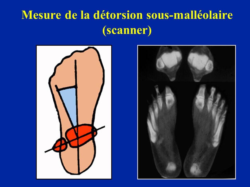 Mesure de la détorsion sous-malléolaire (scanner)